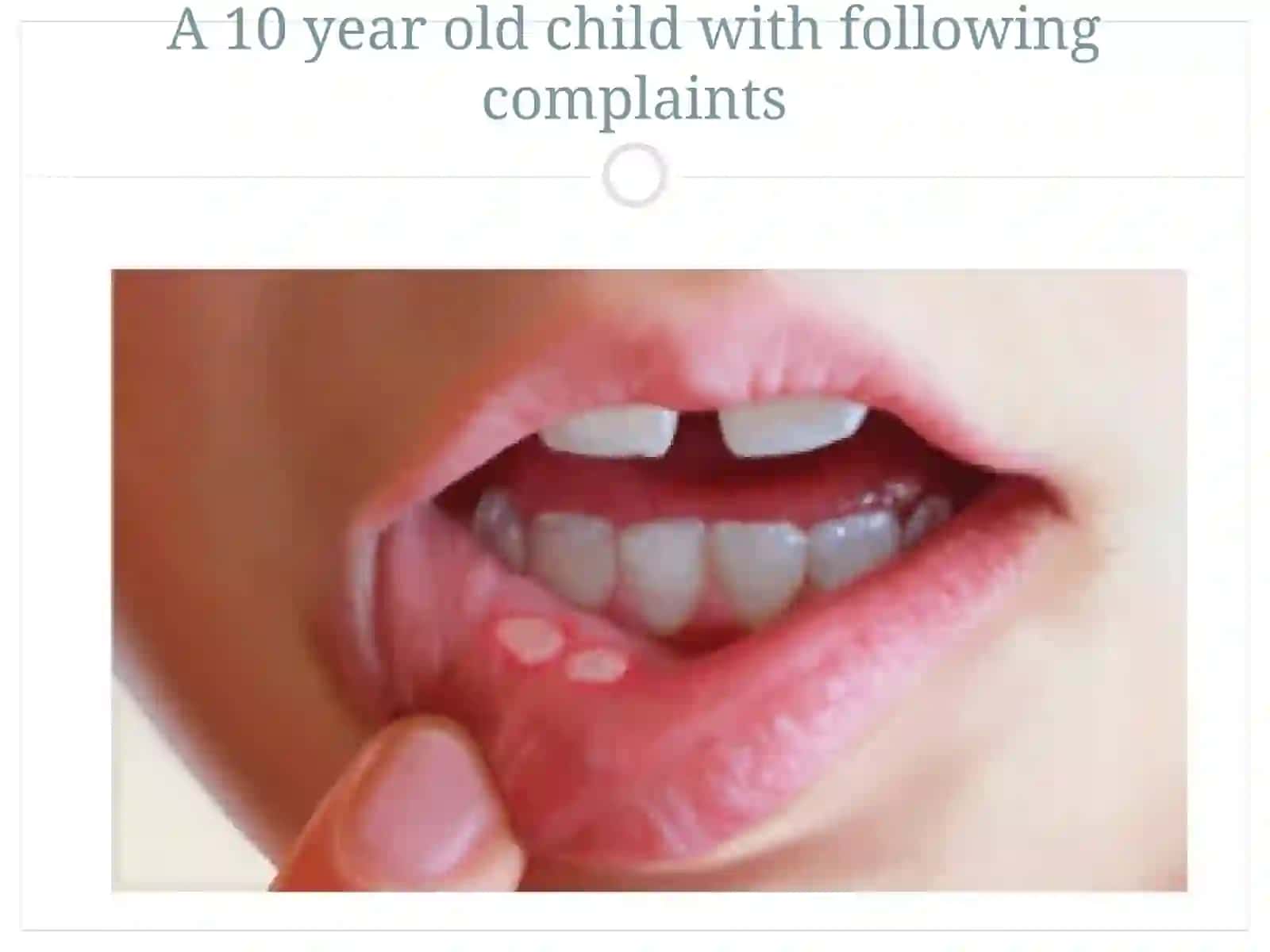 Oral Thrush-treatment 4