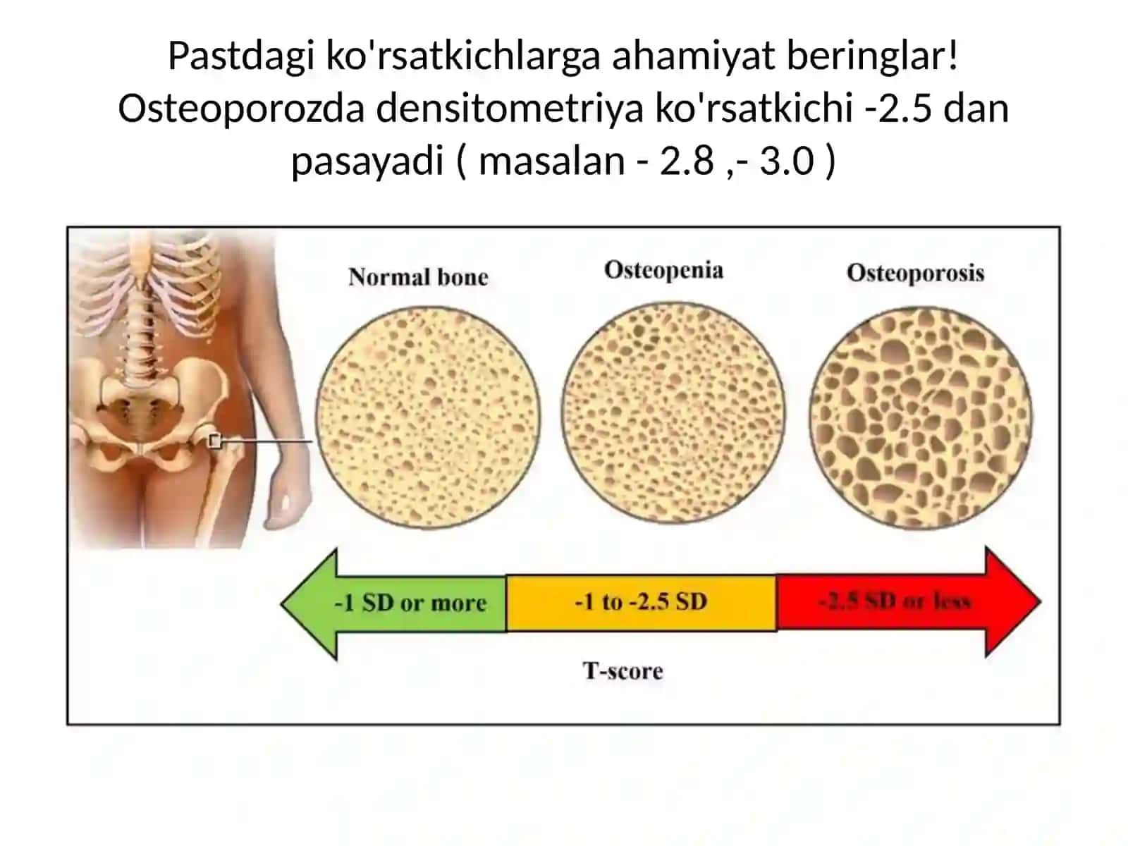 Osteoporoz 4