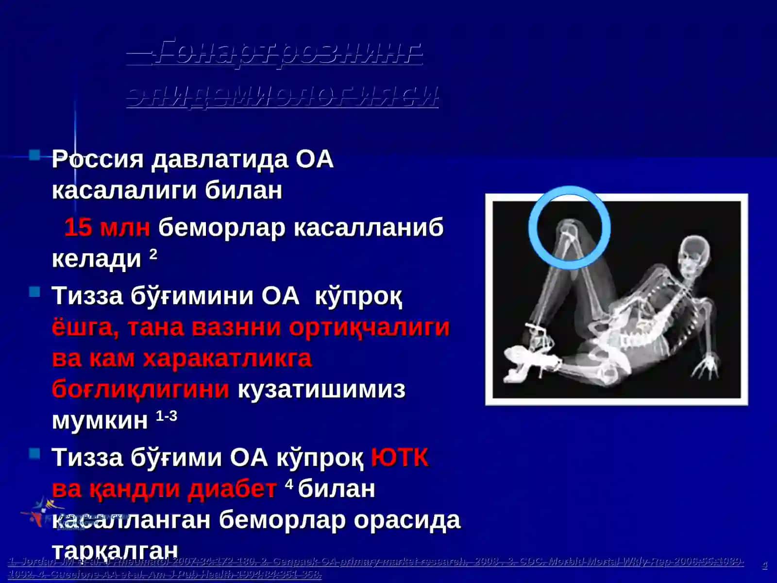 Остеоартрит - касаллиги 4