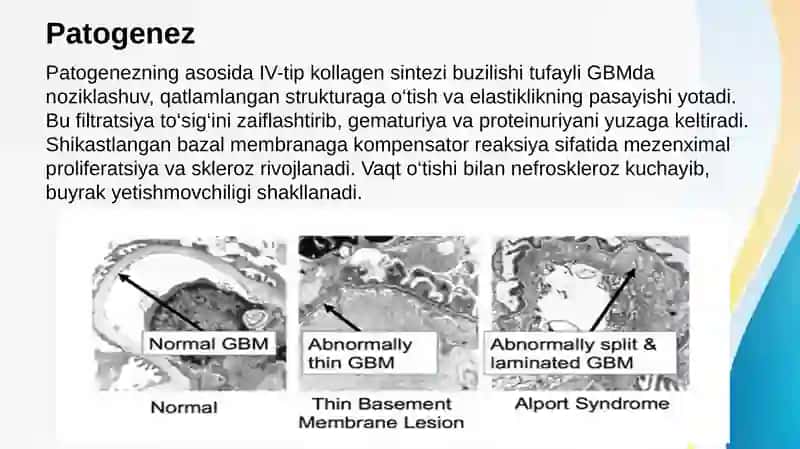 Alport sindromi 4