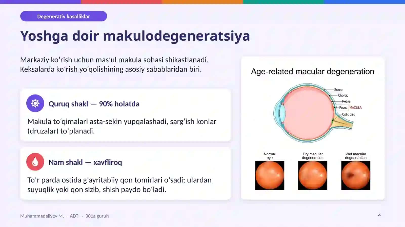 Ko‘z to‘r pardasining degenerativ kasalliklari 4