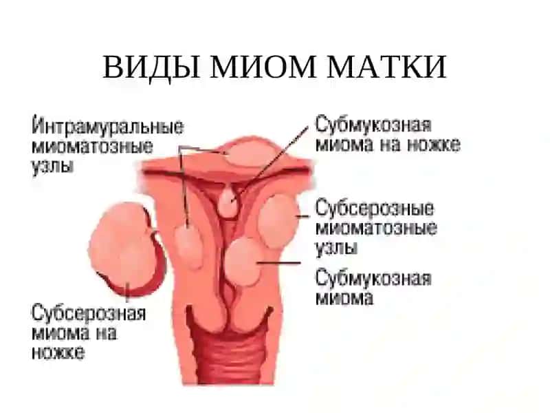 Миома матки 4
