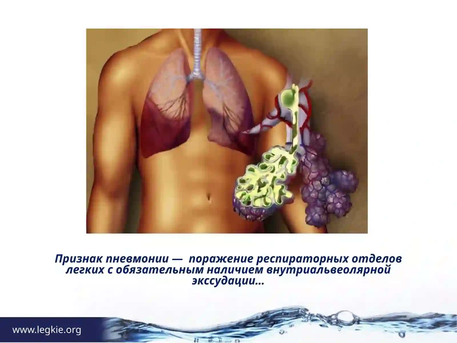 ПНЕВМОНИЯ 4