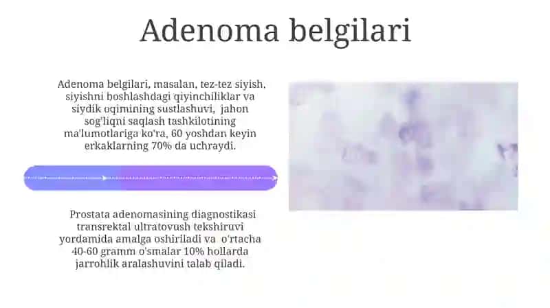 Urologiya adenoma 4