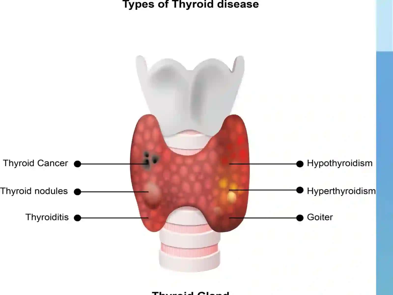 Tireoiditlar 4