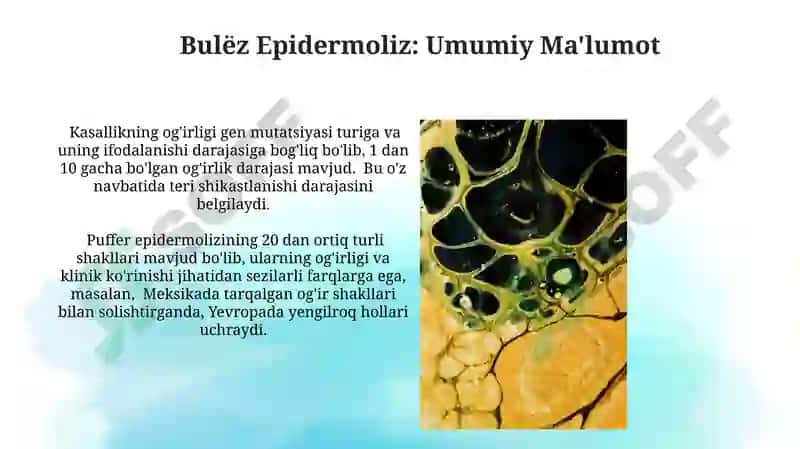 Bullyoz epidermoliz 4