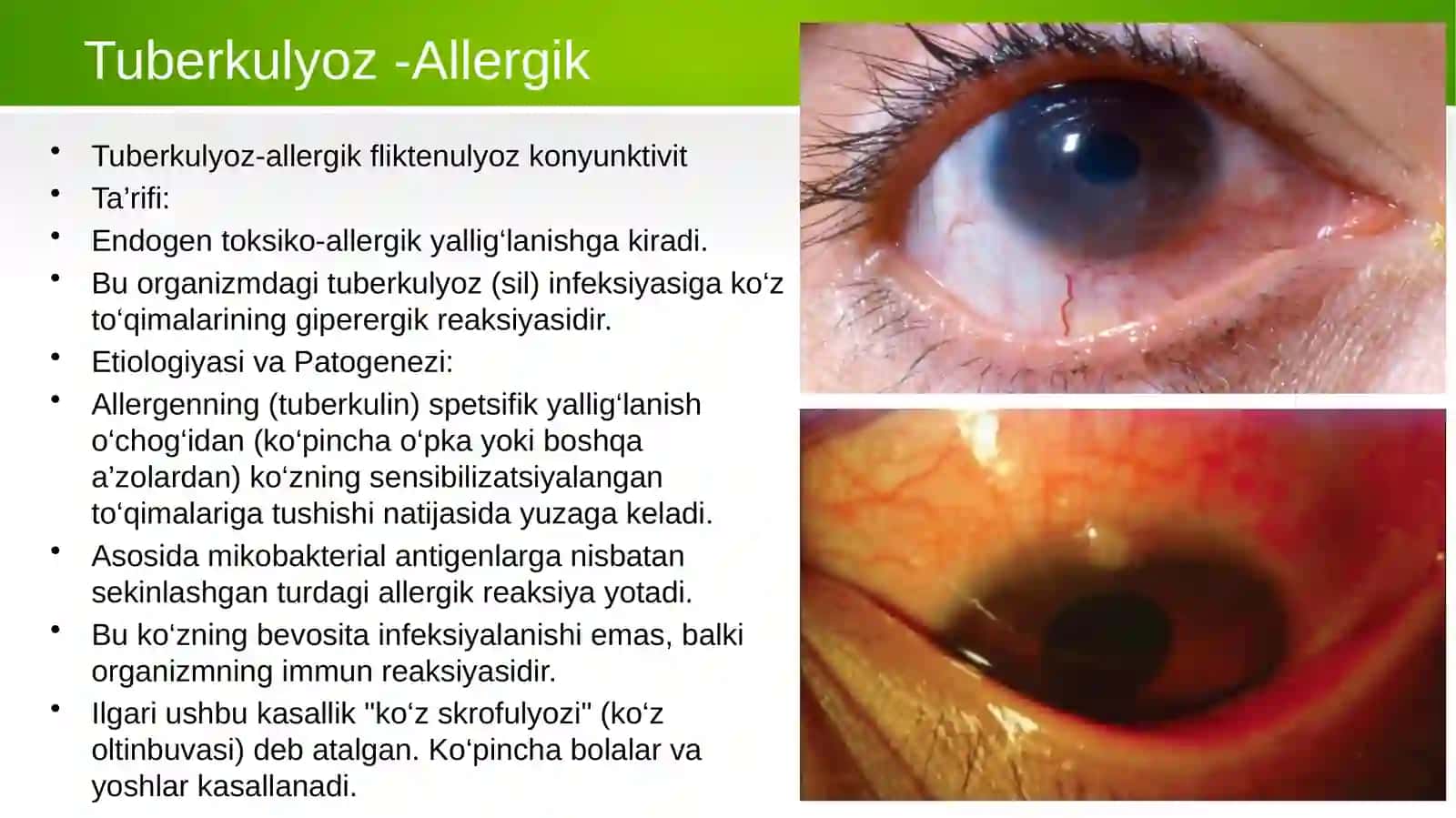 Angulyar diplobatsillyar konyunktivit 4