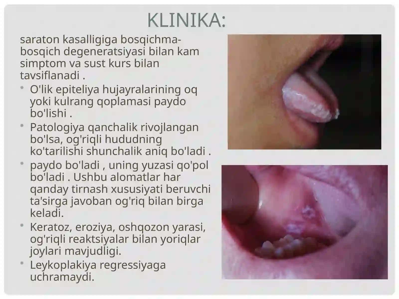 Leykoplakiya 4