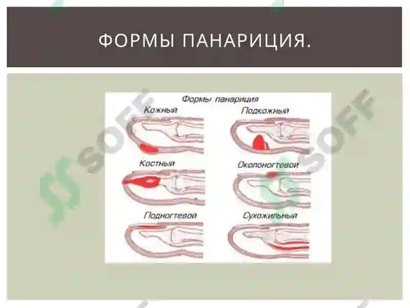 Мастит Панарицый 5