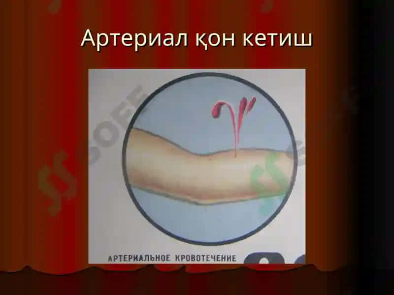 Қон кетиш ва уни тўхтатиш усуллари 5