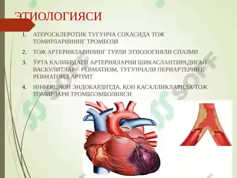 Миокард инфаркти 5