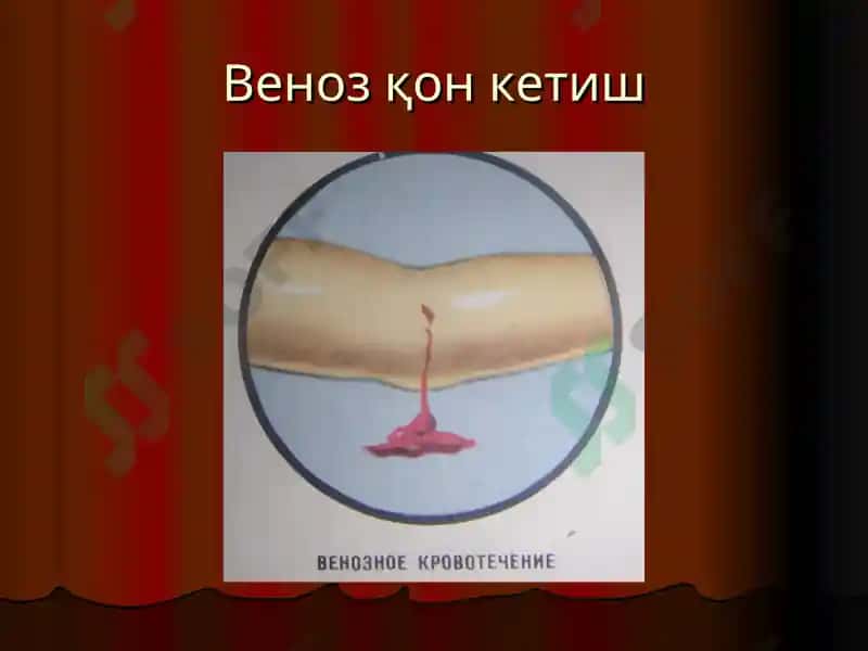 Қон кетиш ва уни тўхтатиш усуллари 6