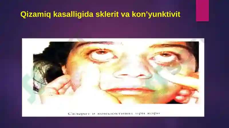 RNK saqlovchi viruslar 7