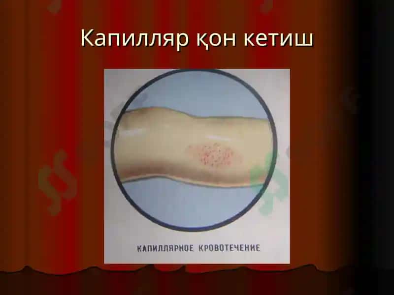Қон кетиш ва уни тўхтатиш усуллари 8