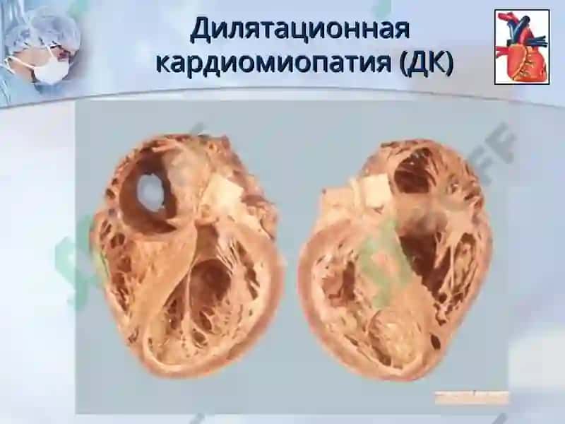 КАРДИОМИОПАТИИ 8