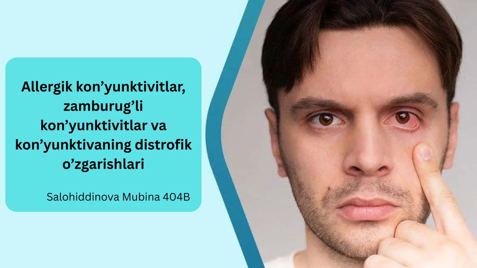 Allergik kon’yunktivitlar
