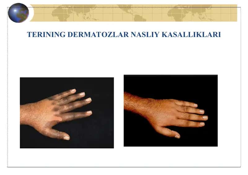 Dermatozlar nasliy kasalliklari