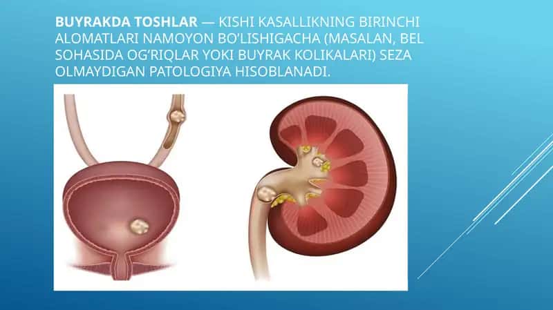 Siydik tosh kasalligi