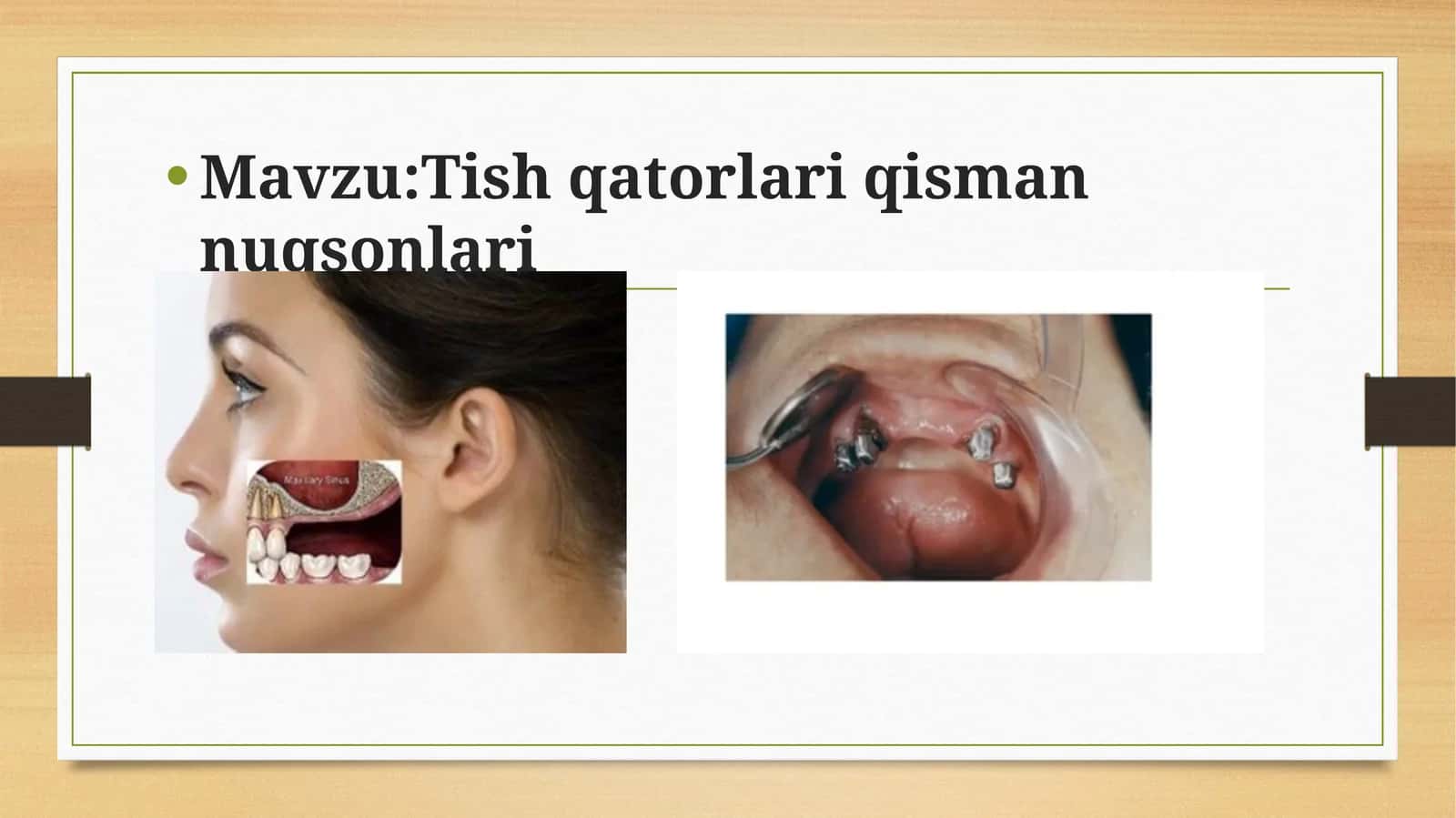 Tish qatorlari qisman nuqsonlari