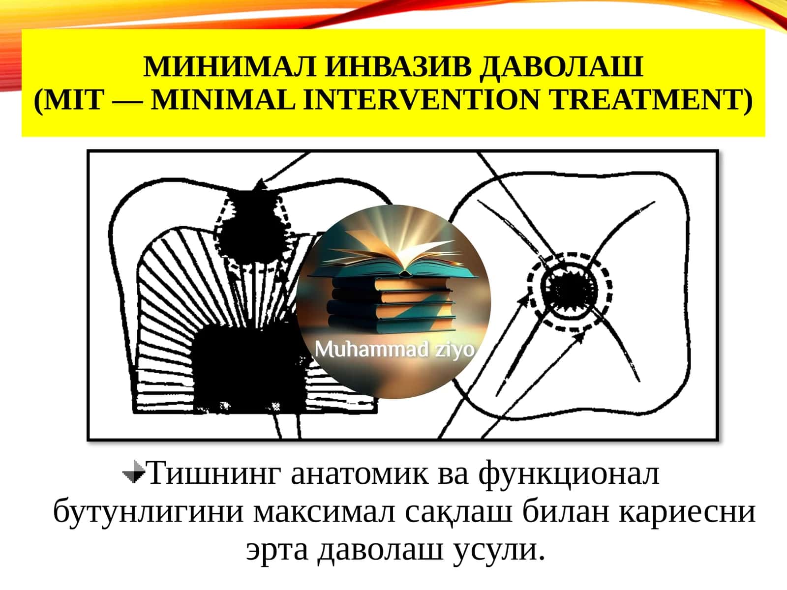 МИНИМАЛ ИНВАЗИВ ДАВОЛАШ(MIT—minimal interventiontreatment)