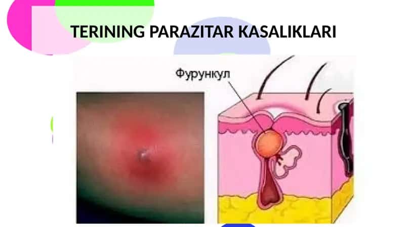 Pyoderma - terining parazitar kasaliklari