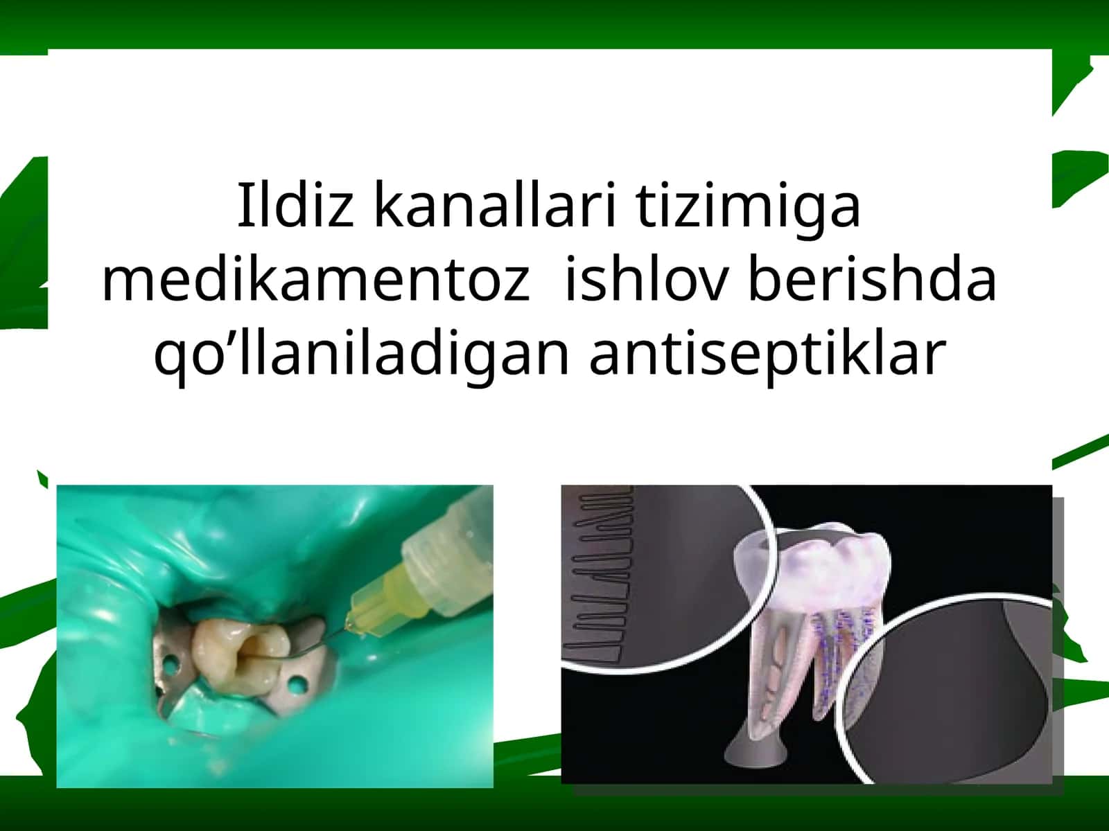 Ildiz kanallari tizimiga medikamentoz ishlov berishda qo’llaniladigan antiseptiklar
