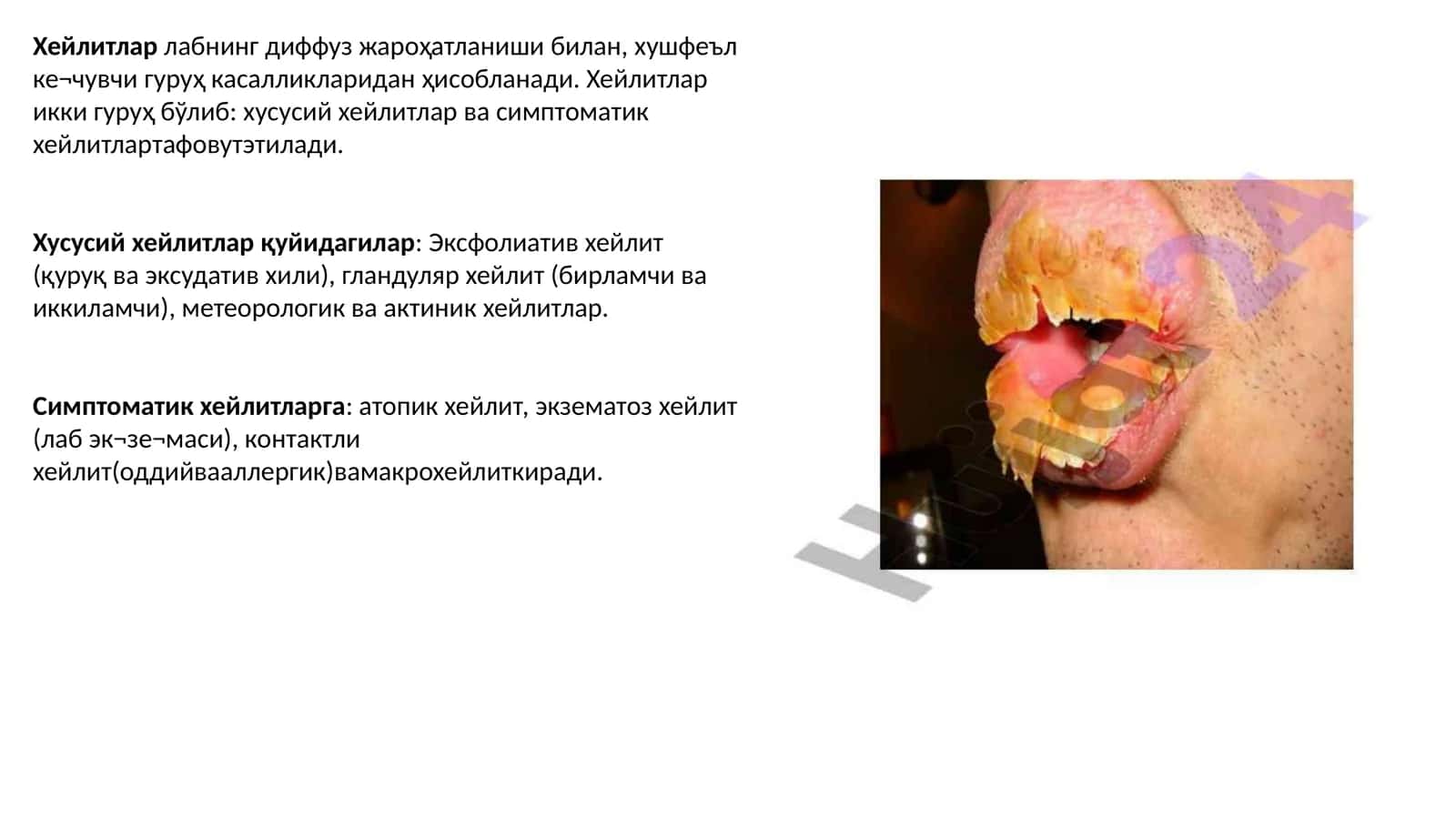 Қуруқ ва эксудатив ҳейлит