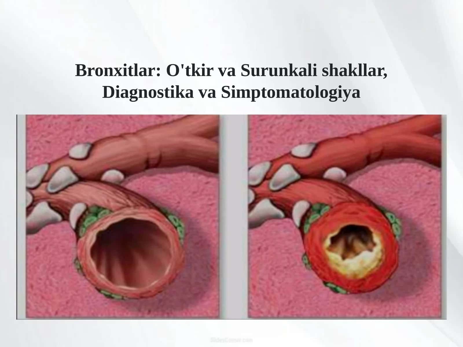 Bronxitlar (o'tkir kriteriyalari. va surunkali) simtomatologiyasi, diagnostikasi