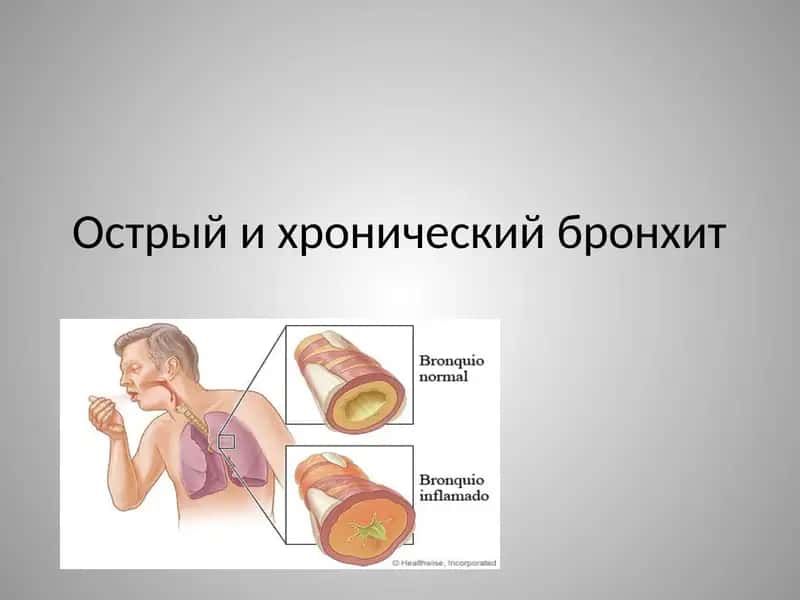 острый и хронический бронхит