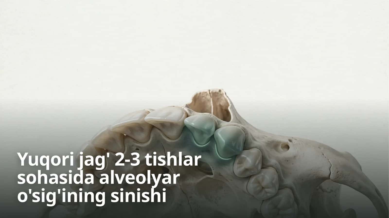 Yuqori jag’ 2-3tishlar sohasida alveolyar o’sig’ining sinishi