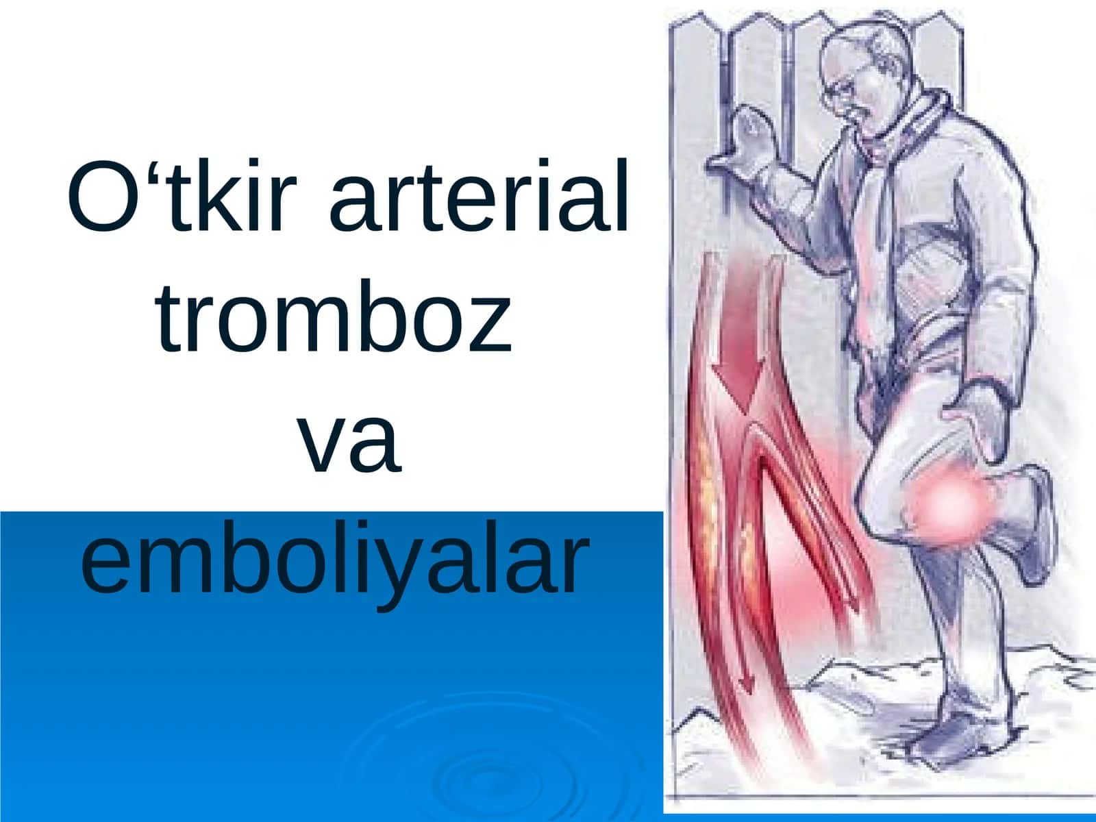 O‘tkir arterial tromboz va emboliyalar