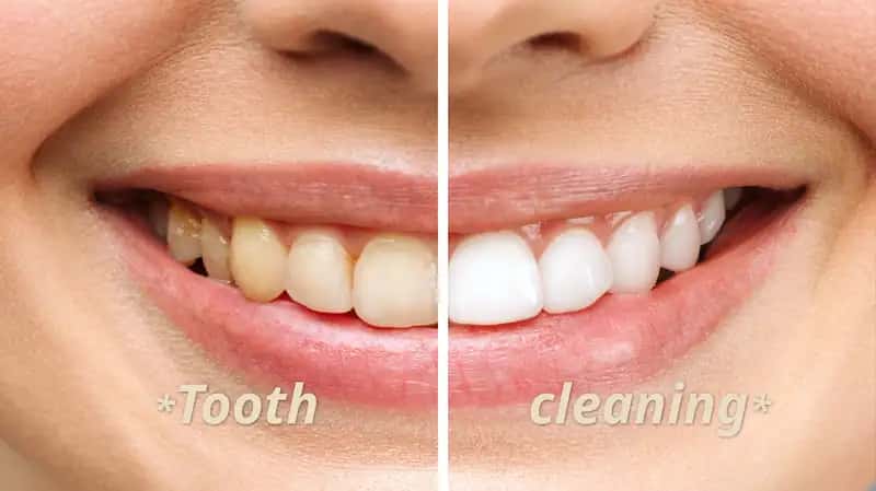 Tooth cleaning