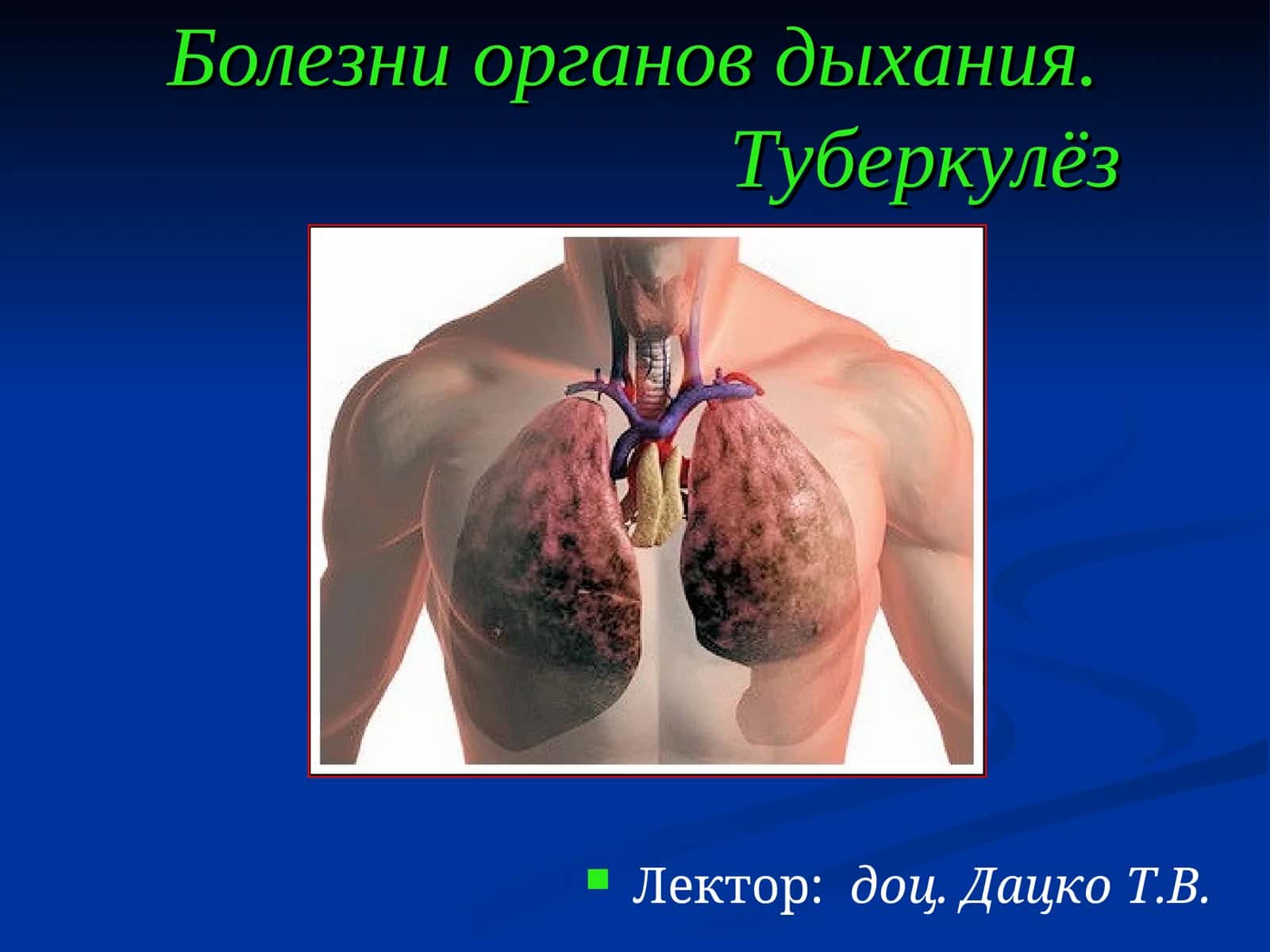 Острый бронхит (bronchitis acuta)