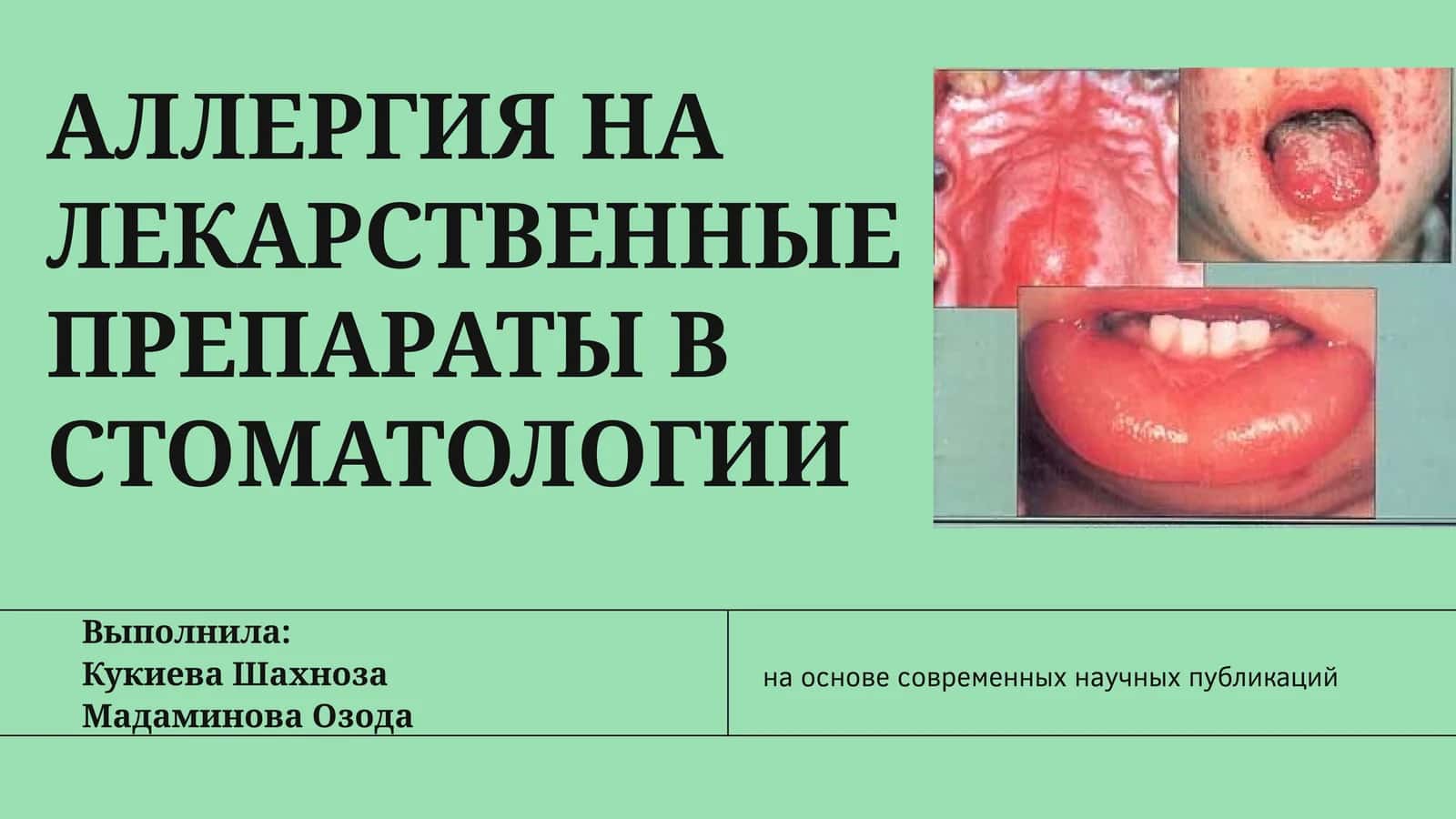 АЛЛЕРГИЯ НА ЛЕКАРСТВЕННЫЕ ПРЕПАРАТЫ В СТОМАТОЛОГИИ