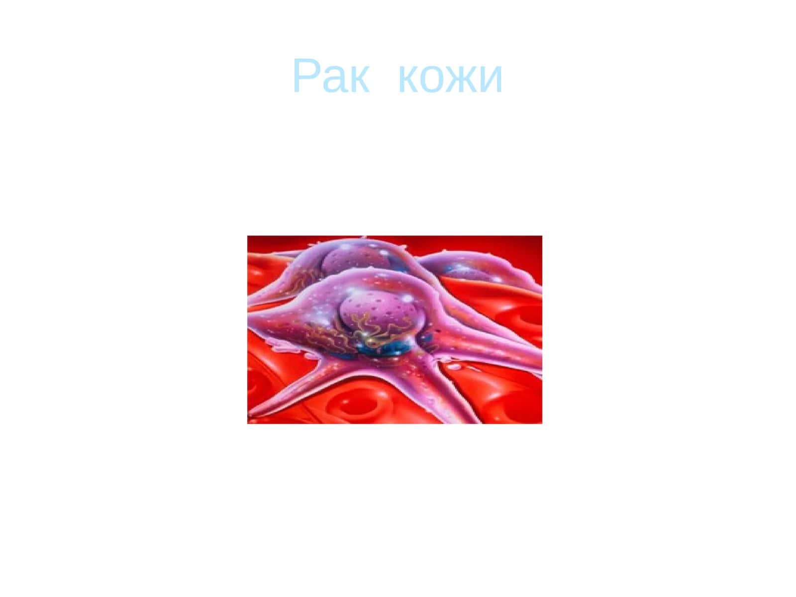 Рак кожи