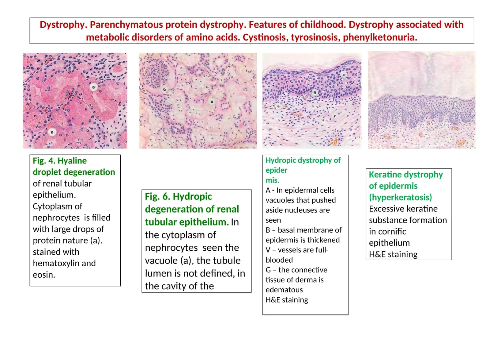Hydropic dystrophy of epidermis