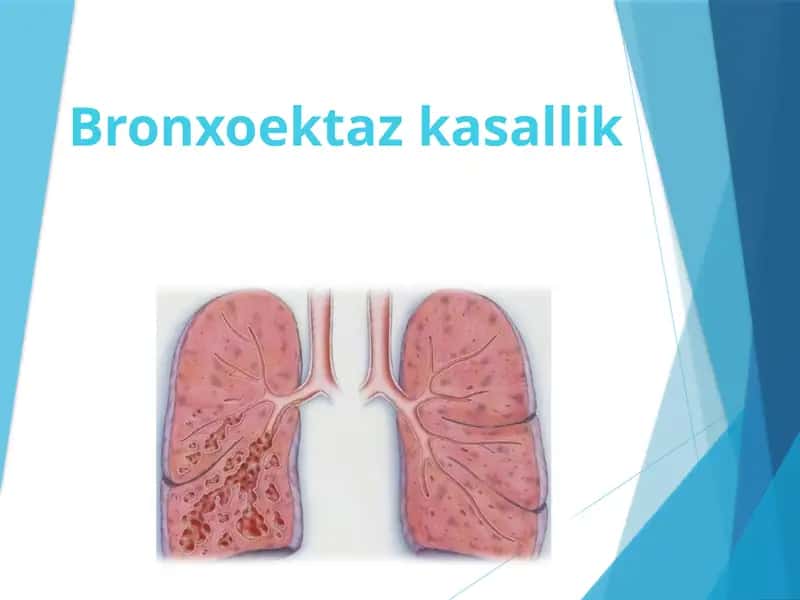 Bronxoektazkasallik
