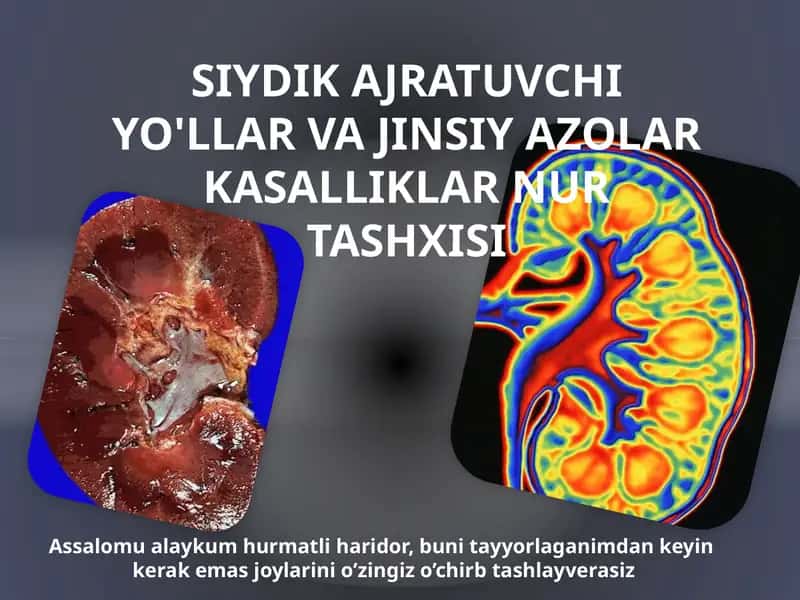 SIYDIK AJRATUVCHI YO'LLAR VA JINSIY AZOLAR KASALLIKLAR NUR TASHXISI