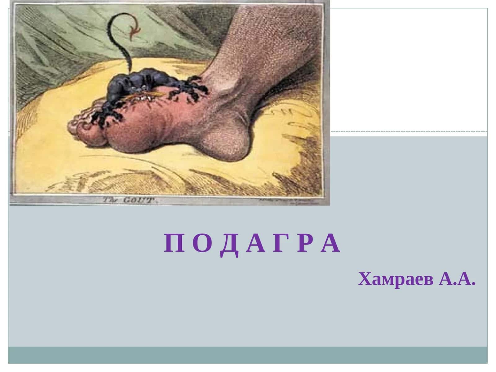 ПОДАГРА