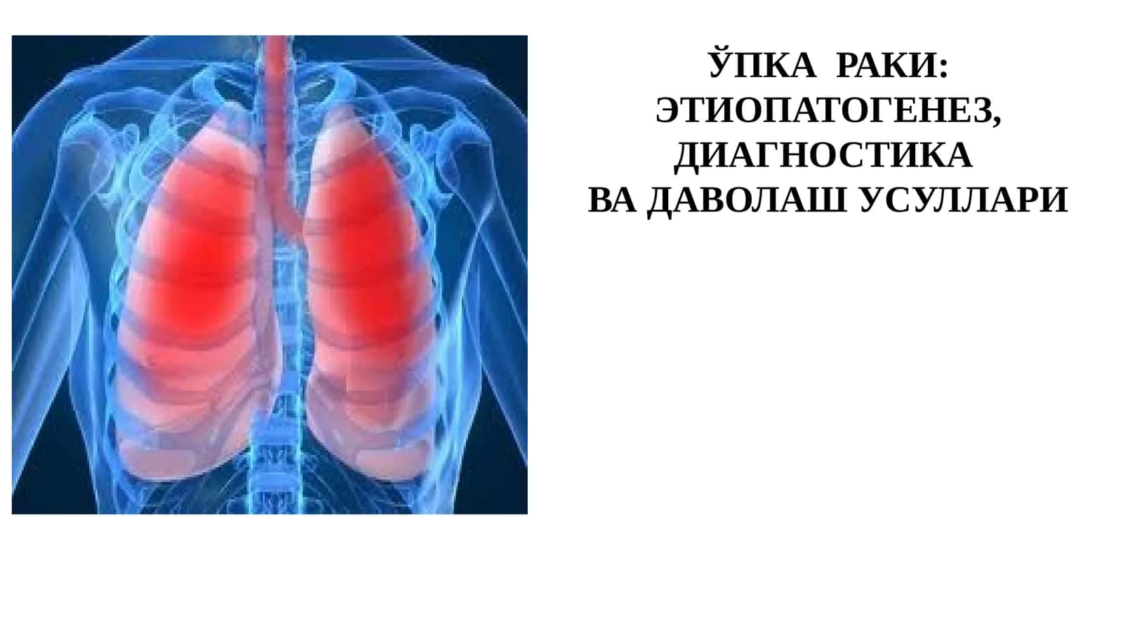 ЎПКА РАКИ: ЭТИОПАТОГЕНЕЗ, ДИАГНОСТИКА ВА ДАВОЛАШ УСУЛЛАРИ