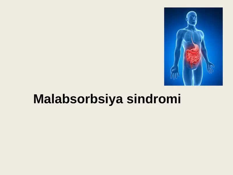 Malabsorbsiya sindromi