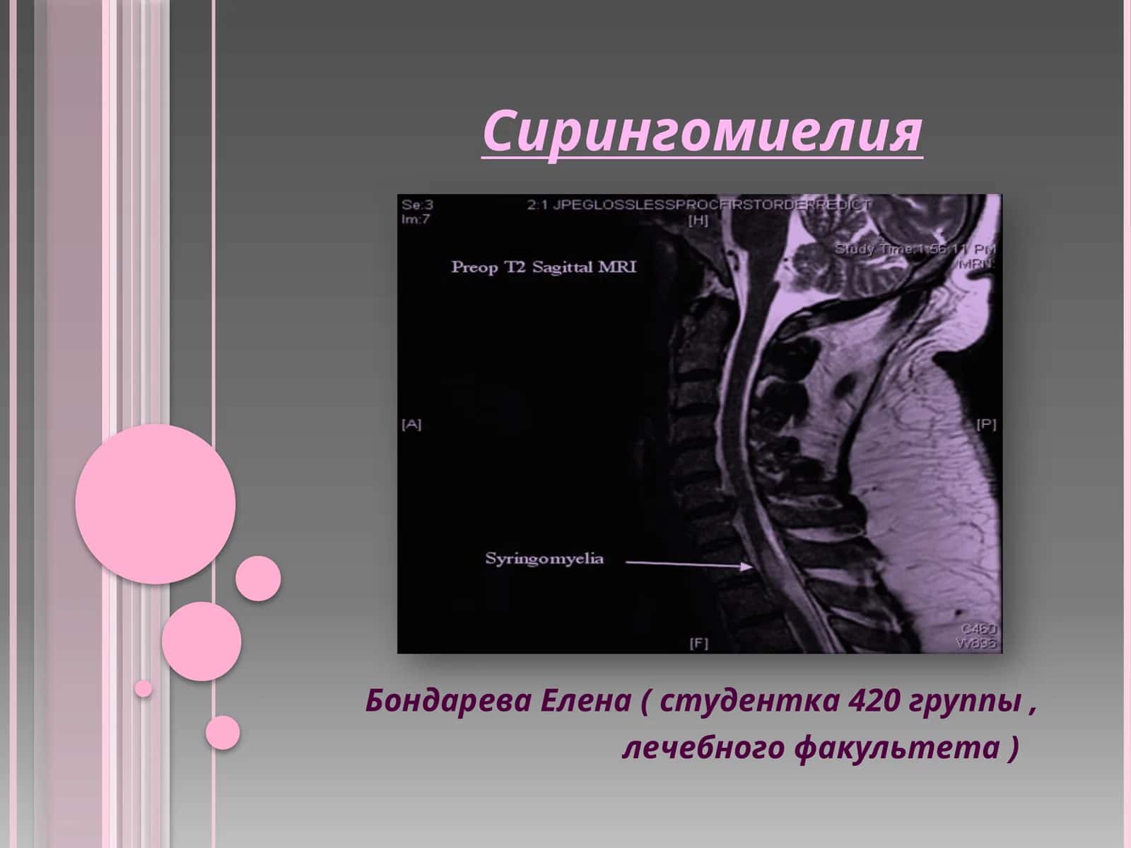 Сирингомиелия