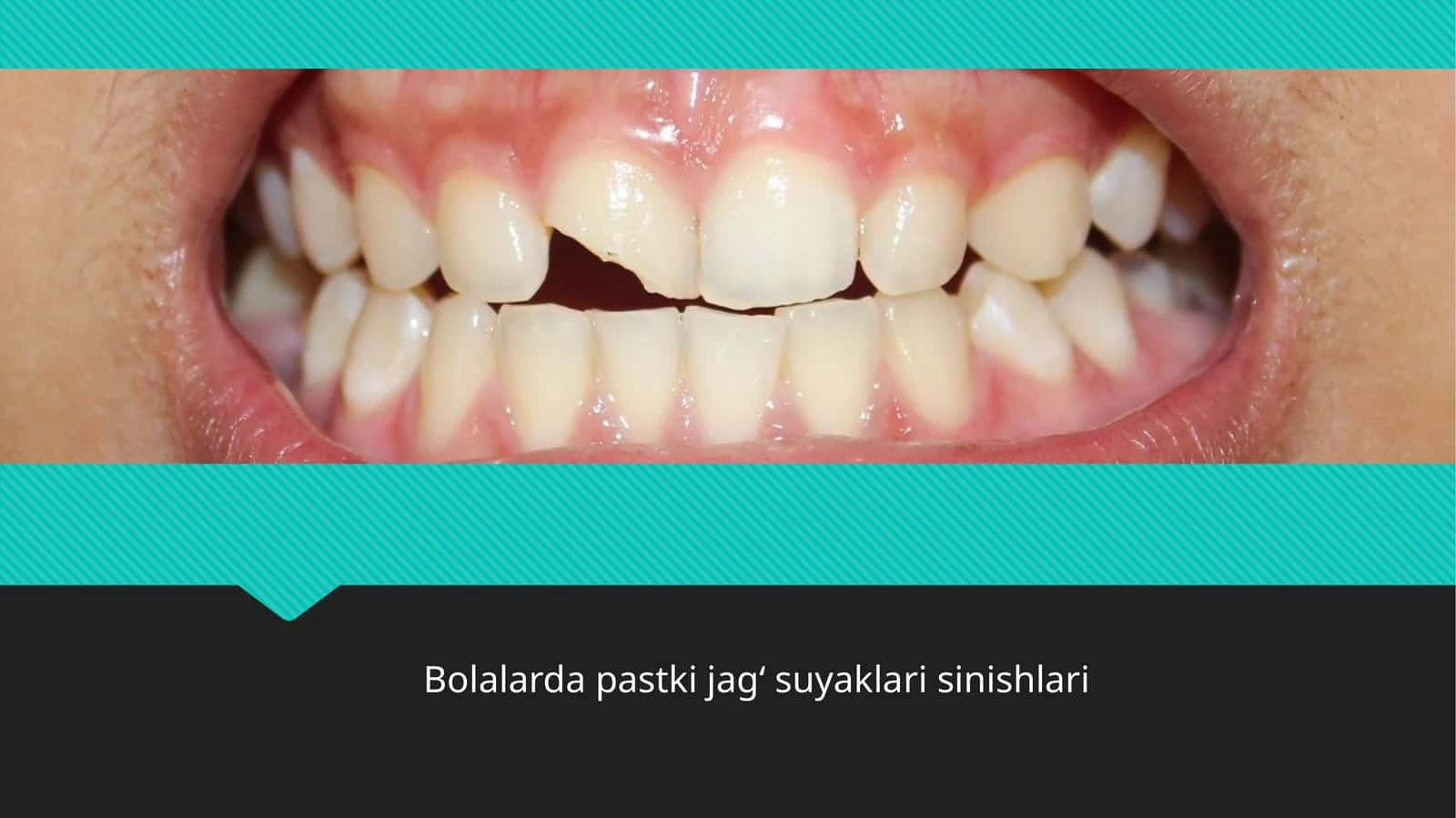 Bolalarda pastki jag‘suyaklari sinishlari