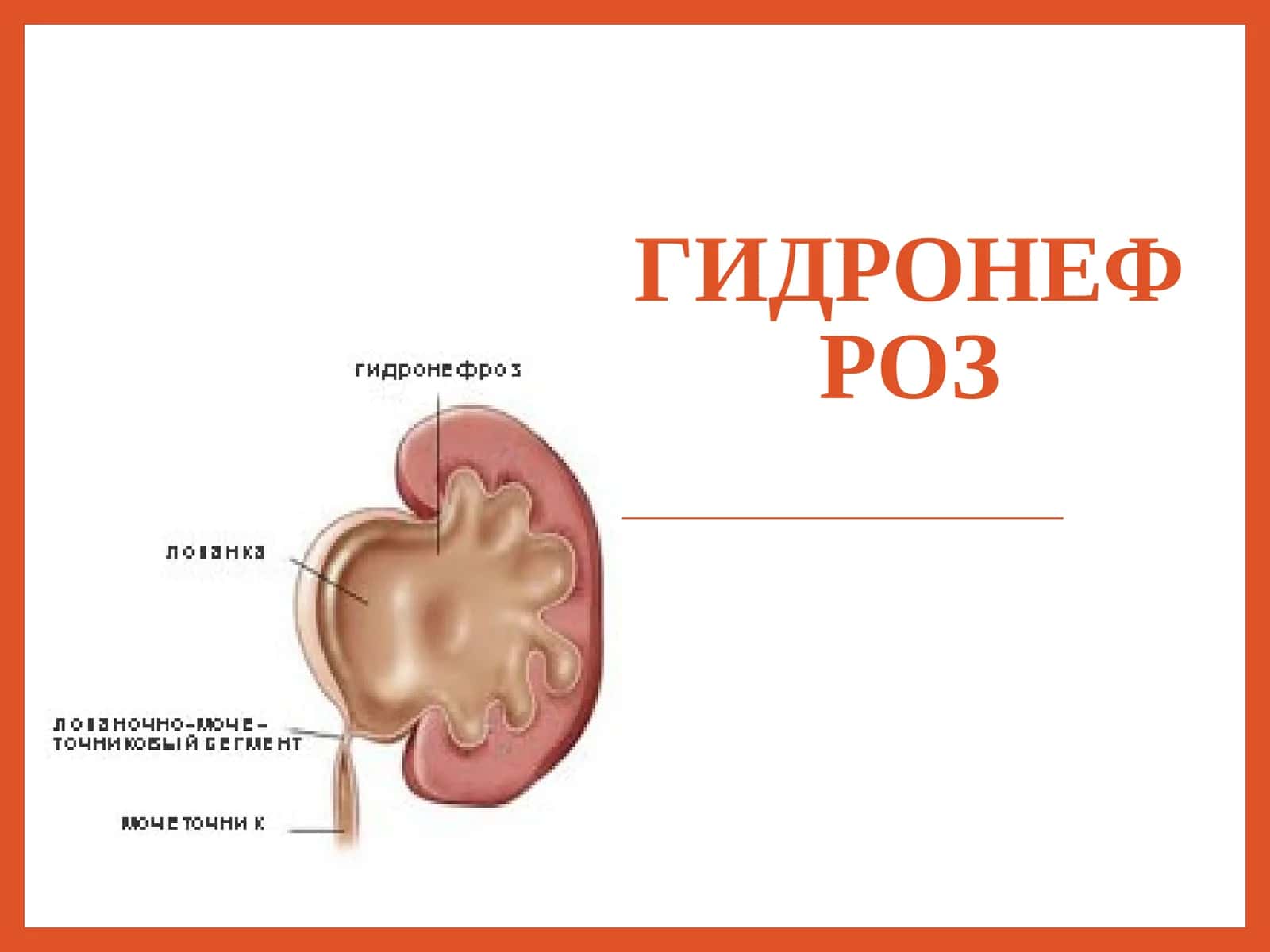 Гидронефроз