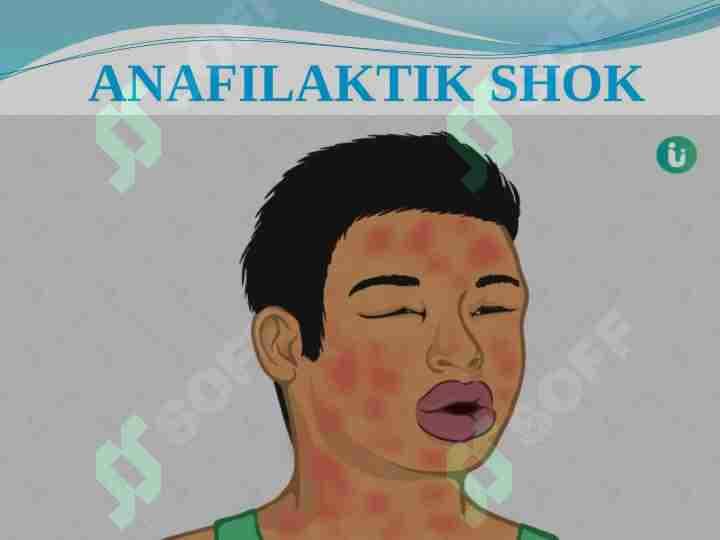 ANAFILAKTIK SHOK