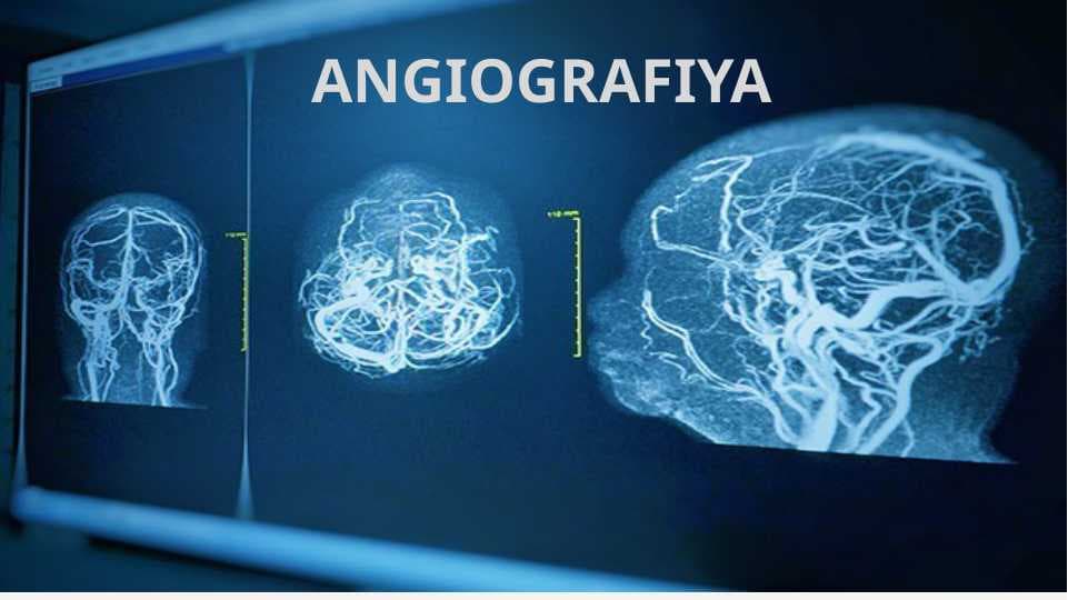 ​ANGIOGRAFIYA​​ ​​