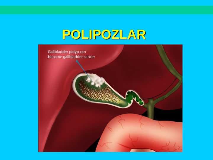 POLIPOZLAR