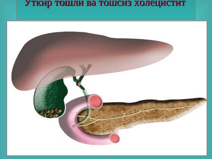 Ўт тош ва тошсиз холецистит