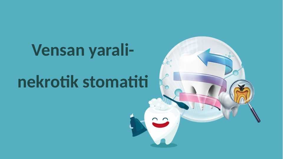 Vensan yarali-nekrotik stomatiti