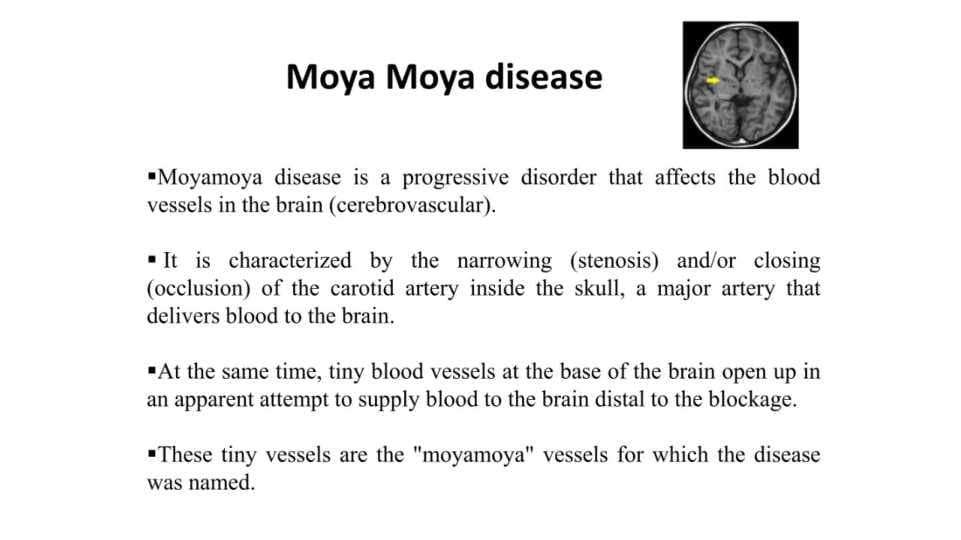 Moya Moya disease . Moya moya kasalligi